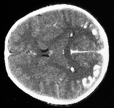 Extra-Intestinal Manifestations of Coeliac Disease in Children: Clinical Features and Mechanisms